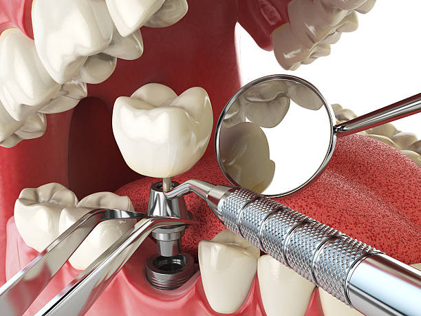 Best Emergency Dentist for Lost Fillings or Crowns in Glenwood City, WI